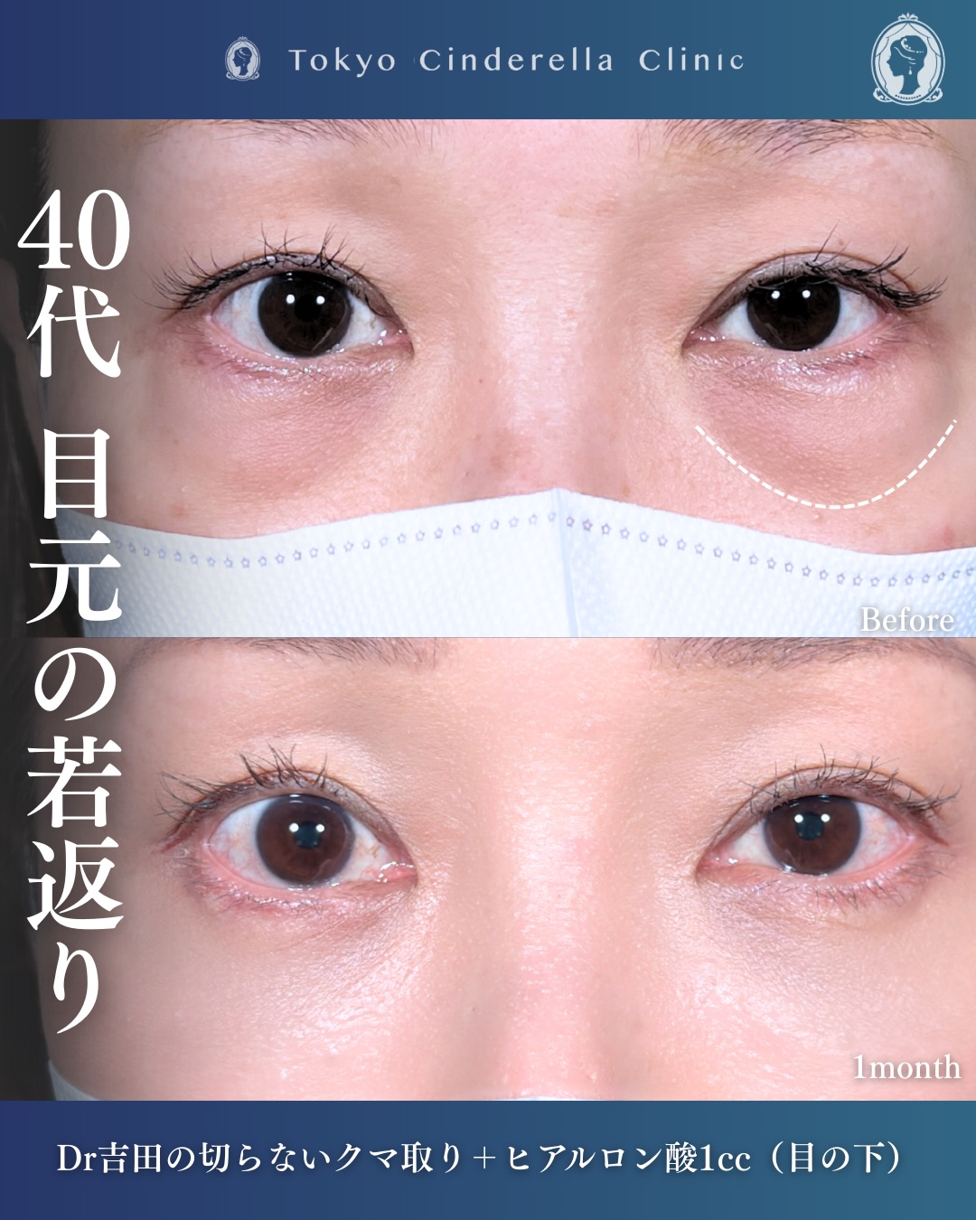 新宿院で行なった吉田利之医師の切らないクマ取りと目の下のヒアルロン酸注入の1ヵ月後の症例写真