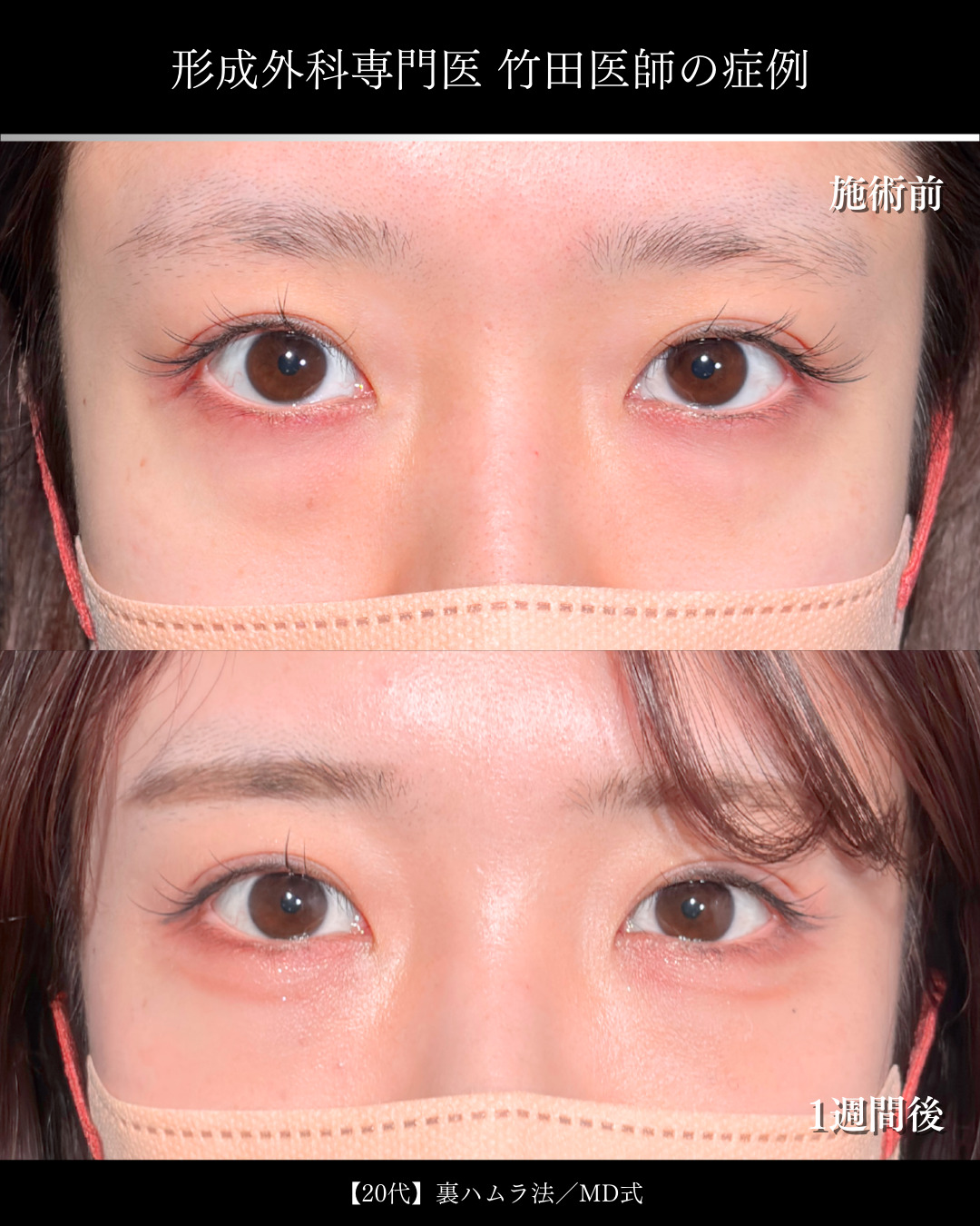 大宮院で行なった竹田昌平医師の裏ハムラ法の例写真