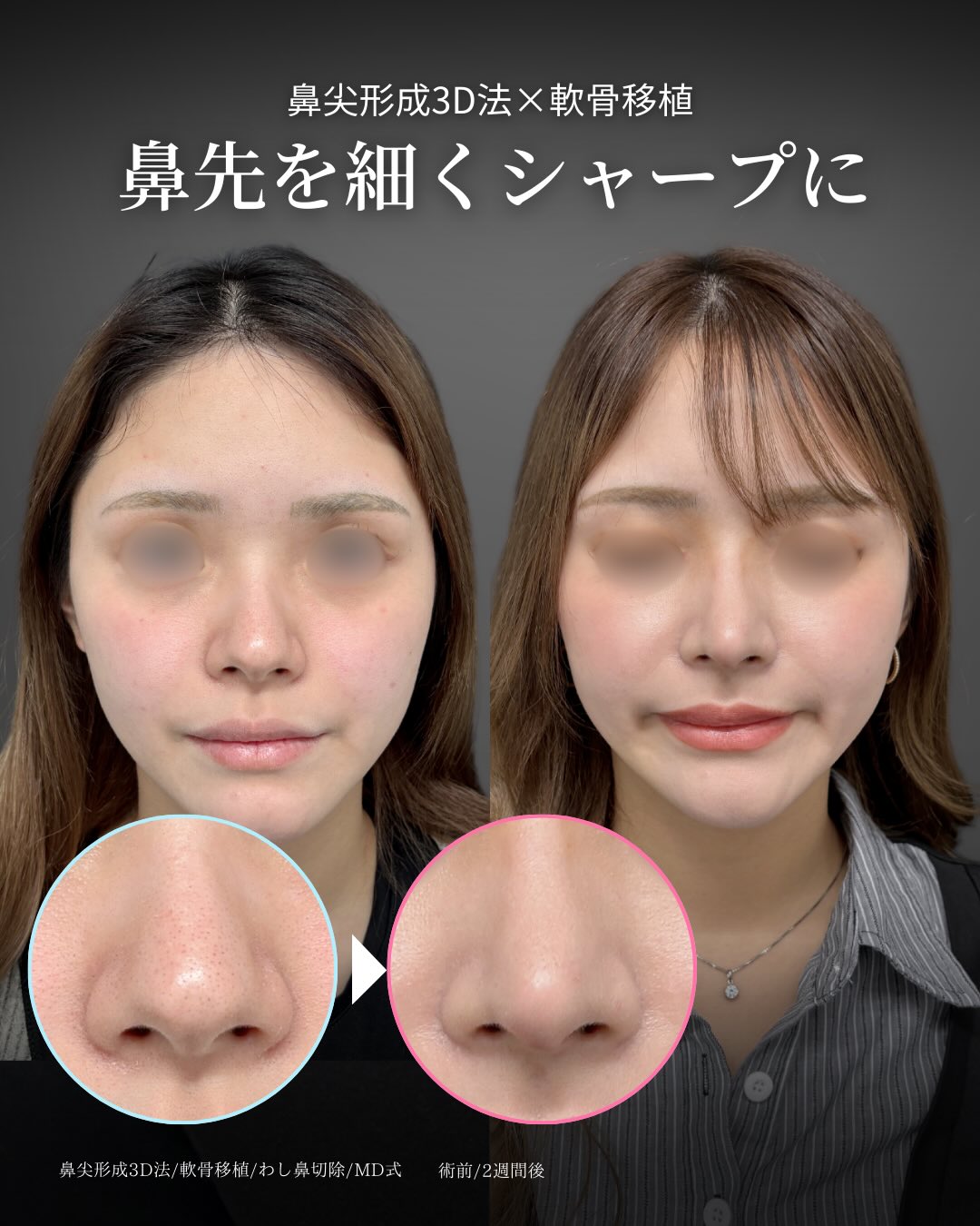 鼻整形のお勧め術式を医師が大公開｜新宿・池袋・大宮・横浜で人気の