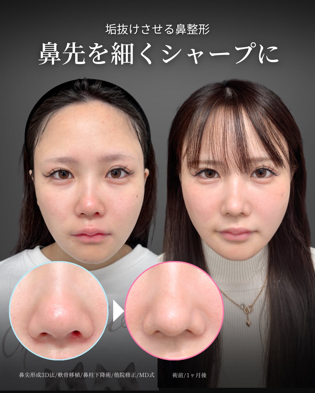 別人級の鼻整形 」に関する美容整形の症例写真の詳細 | 新宿・池袋・大宮・横浜で人気の美容整形は東京シンデレラ美容外科