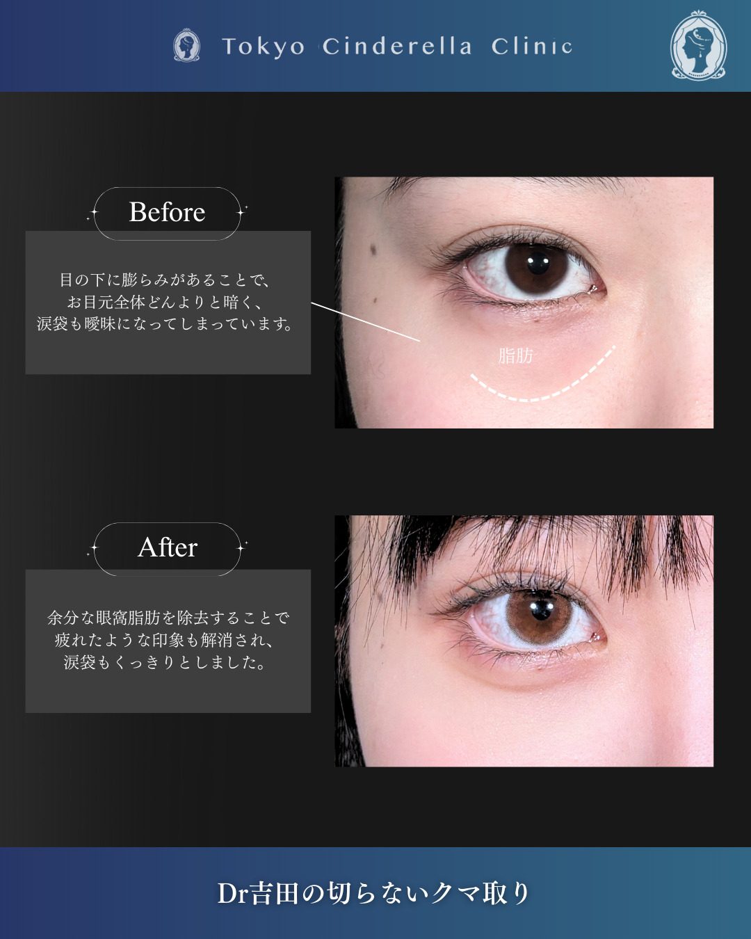 新宿院で行なったクマ取りで有名な吉田利之医師の切らないクマ取りの1週間後の症例写真