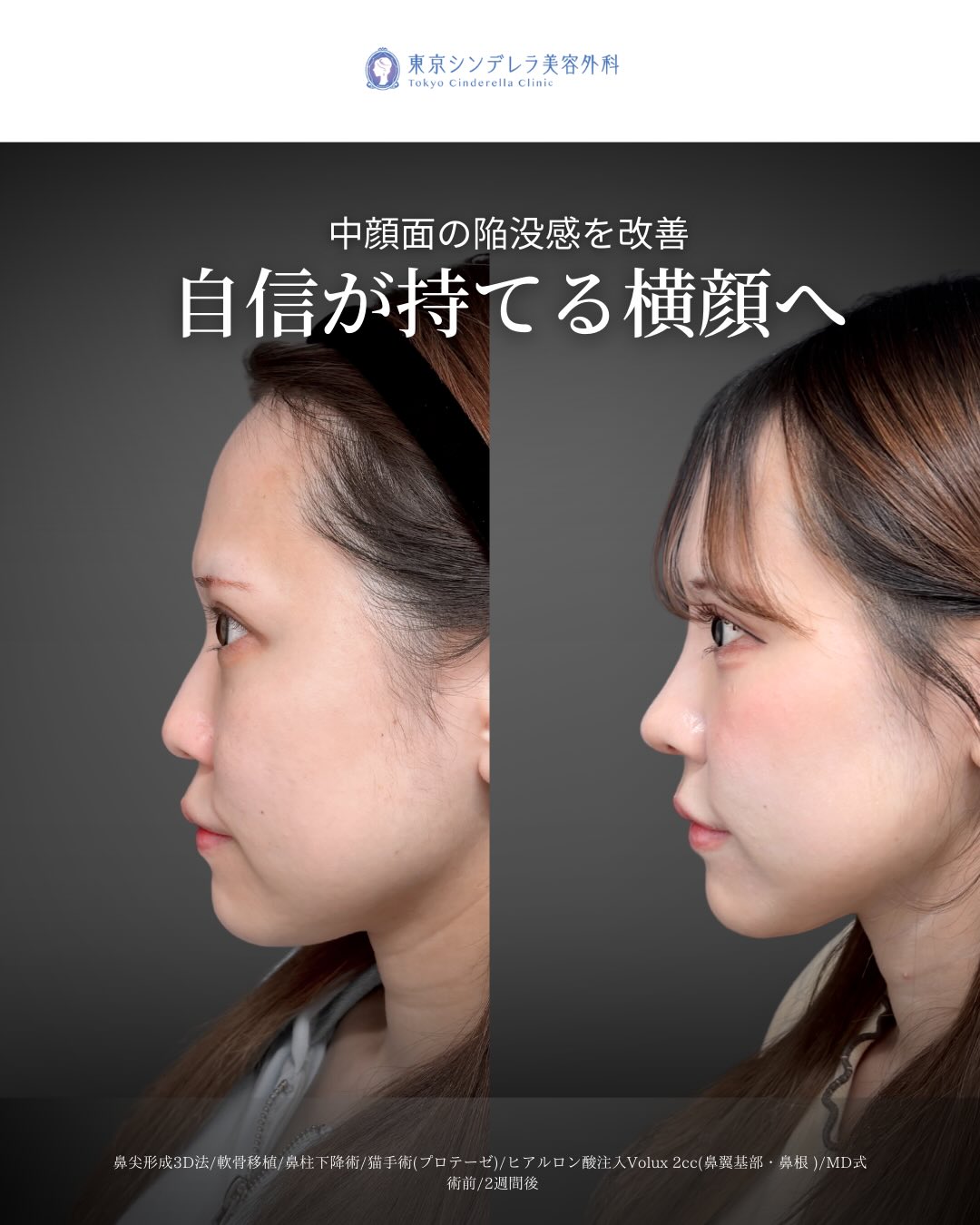 猫手術(鼻唇角形成術) の症例写真一覧｜ 新宿・池袋・大宮・横浜で人気