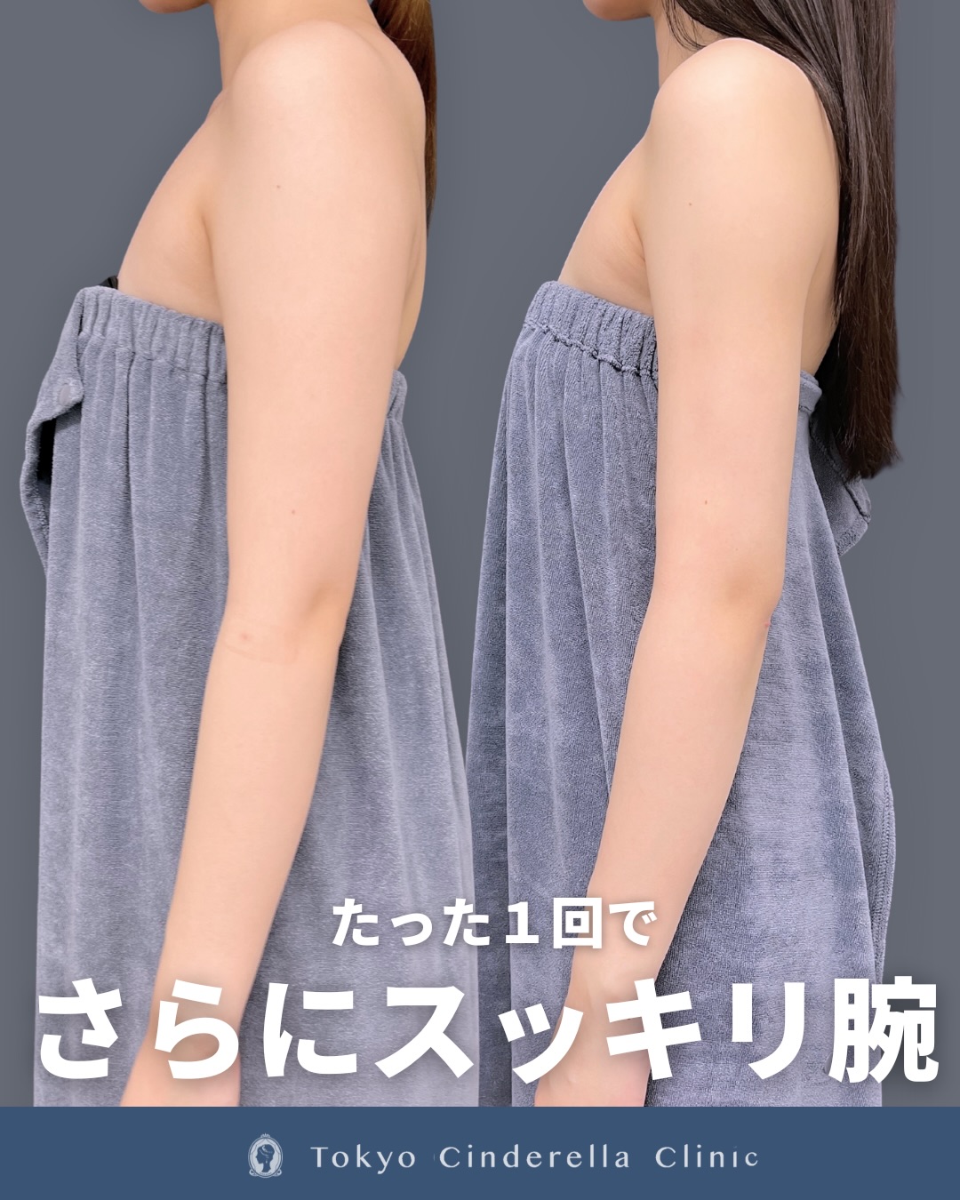 新宿院で行った二の腕と肩のアキーセル脂肪吸引の名医の吉原伯医師の3ヵ月後の症例写真