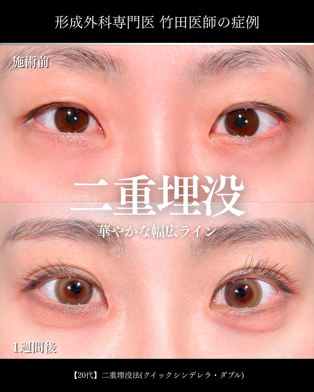 目の開き左右差を極限まで調整 」に関する美容整形の症例写真の詳細