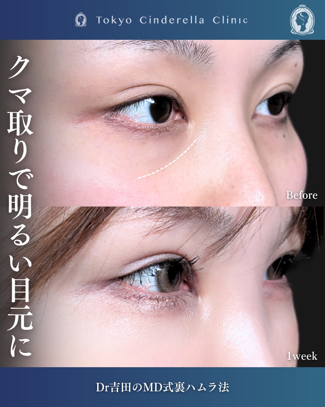 新宿院で行なったクマ取りで有名な吉田利之医師のMD式裏ハムラ法の1週間後の症例写真