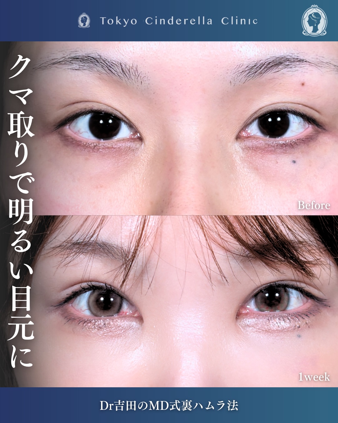 新宿院で行なったクマ取りで有名な吉田利之医師のMD式裏ハムラ法の1週間後の症例写真