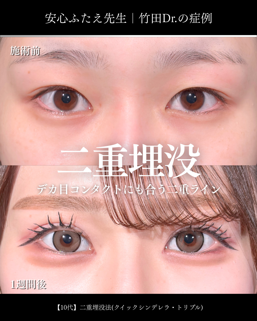 EYEeyelid surgeryセレクト美容塾・眼瞼　美容外科形成外科 デカ目コンタクトでも映える二重 」に関する美容整形の症例写真の詳細