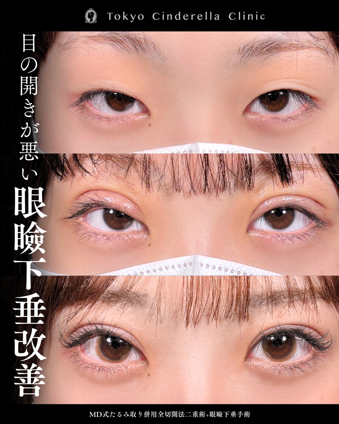 眼瞼下垂のチェックする方法を医師が解説｜美容整形は東京シンデレラ