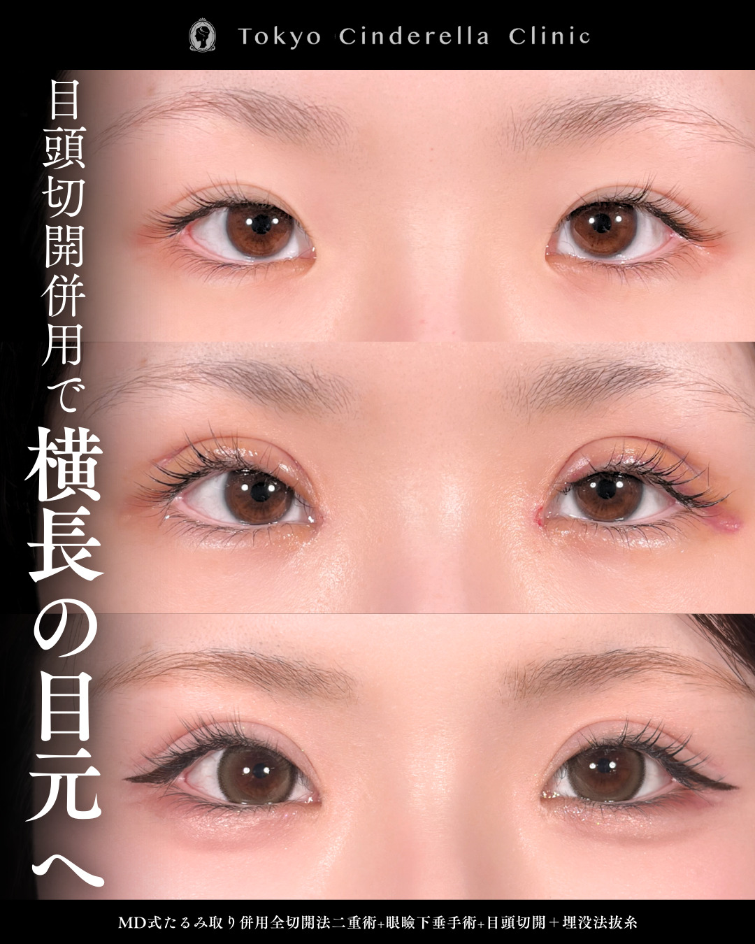 眼瞼下垂のチェックする方法を医師が解説｜美容整形は東京シンデレラ