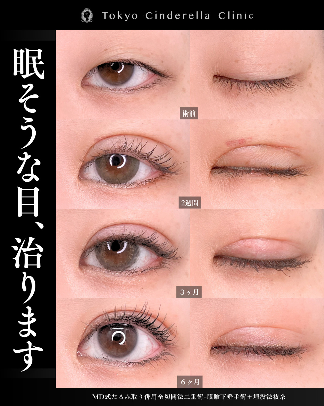 眼瞼下垂のチェックする方法を医師が解説｜美容整形は東京シンデレラ