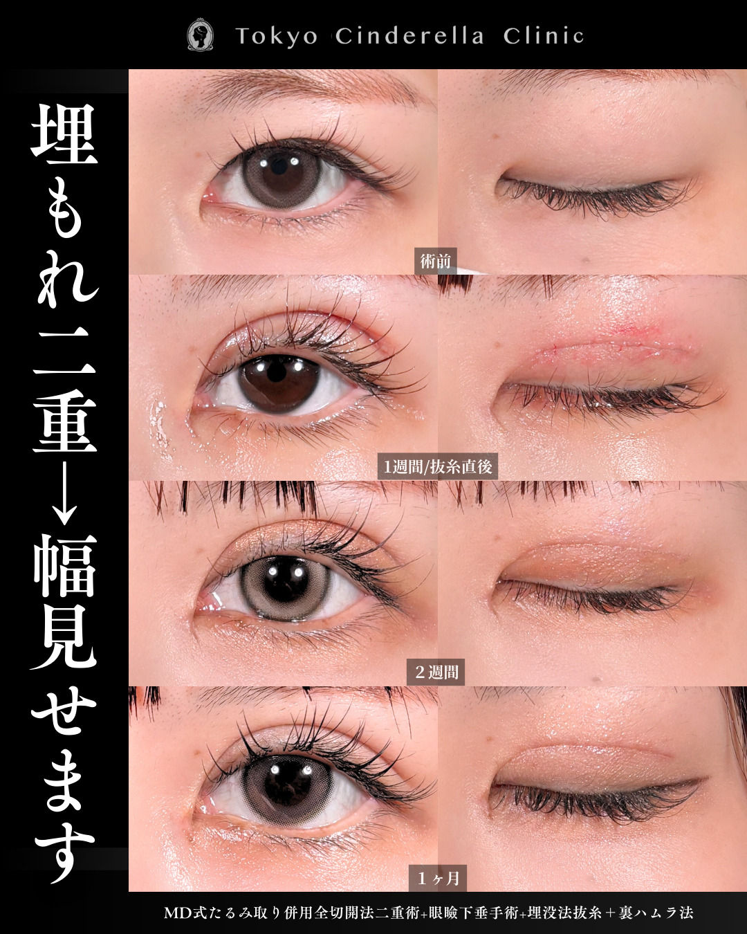 美容眼瞼下垂手術テキスト（英語版） 眼瞼下垂は保険適用か医師が解説｜美容整形は東京シンデレラ美容外科