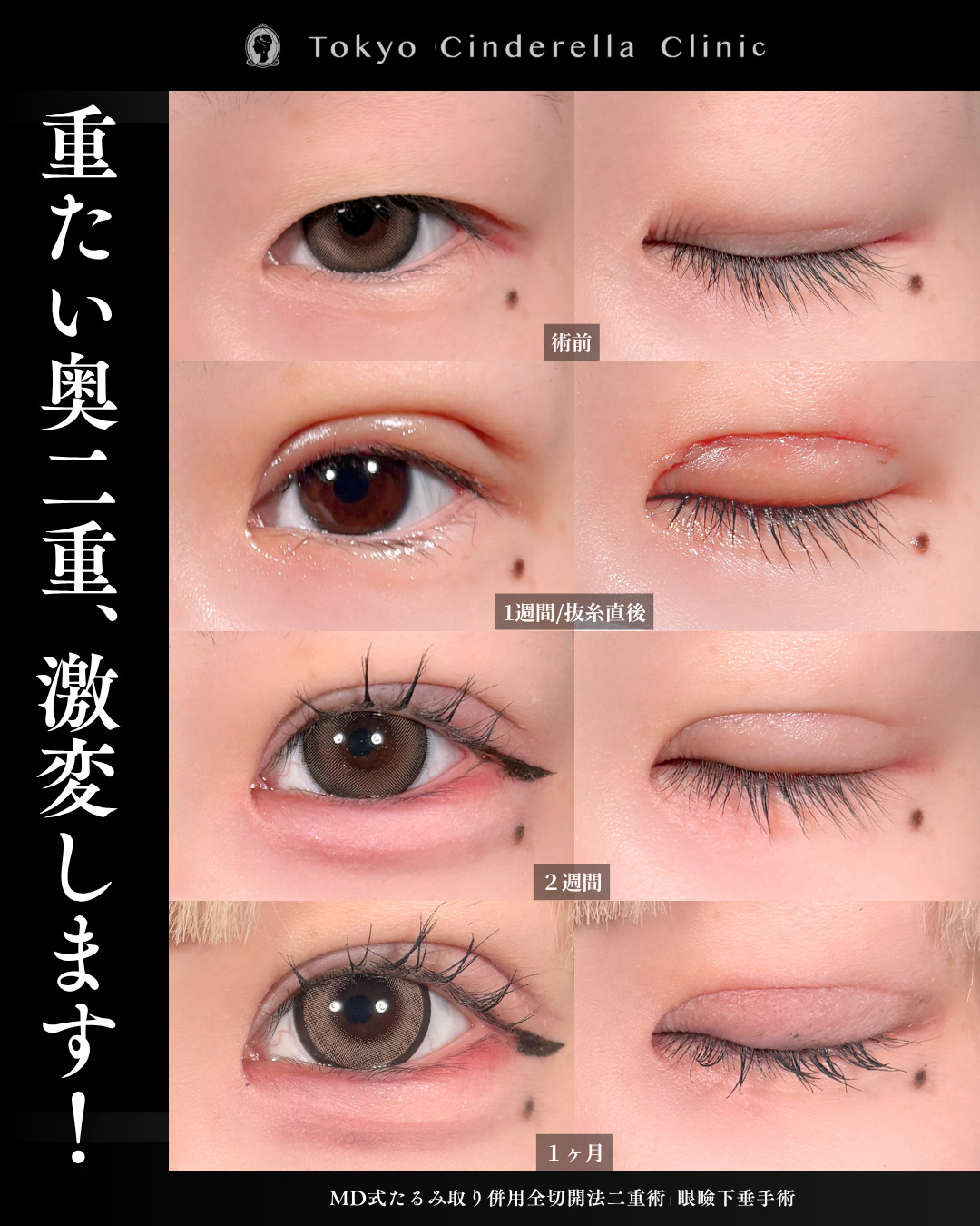 眼瞼下垂は何科で受けるべき？医師が解説｜美容整形は東京シンデレラ
