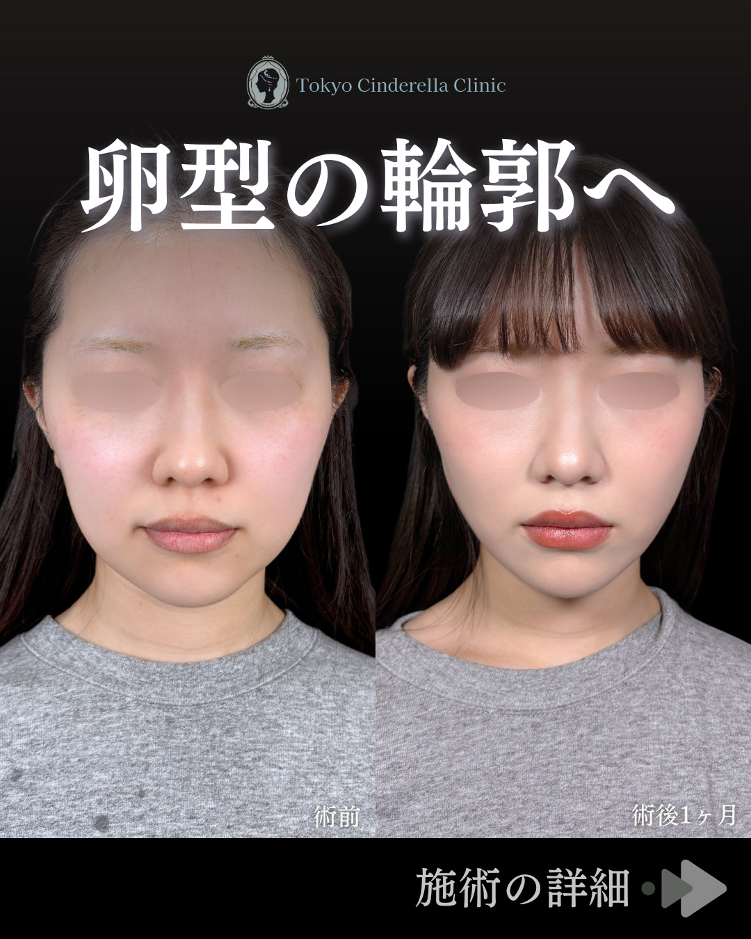 二重幅8mm 」に関する美容整形の症例写真の詳細 | 新宿・池袋・大宮