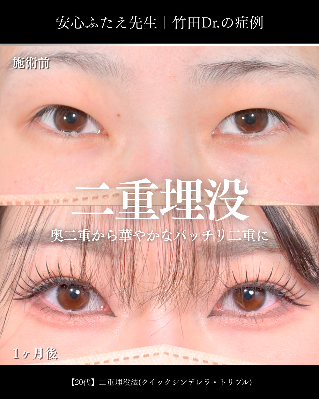 【中古】 美容整形を受ける人のために 切らない二重切開術後の修正術（まつ毛の向きや手術後に開き難くなった