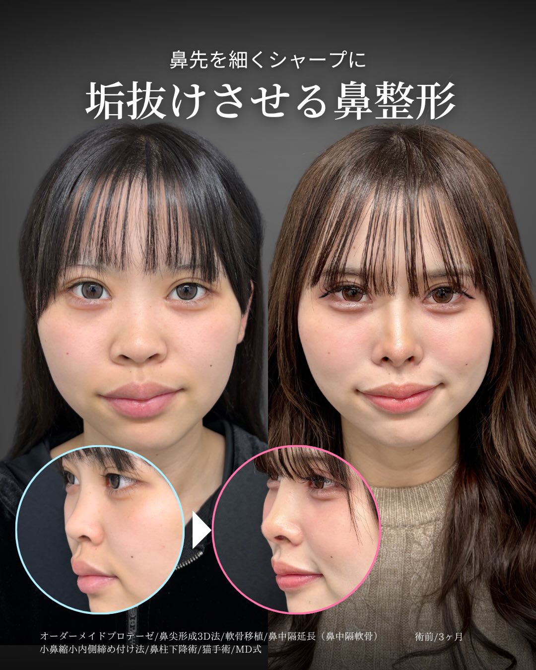 新宿で鼻中隔延長が上手い美容外科の探し方やポイントを解説 ｜美容
