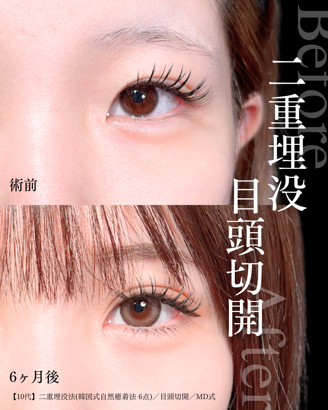 埋没と目頭切開で理想の二重 」に関する美容整形の症例写真の詳細