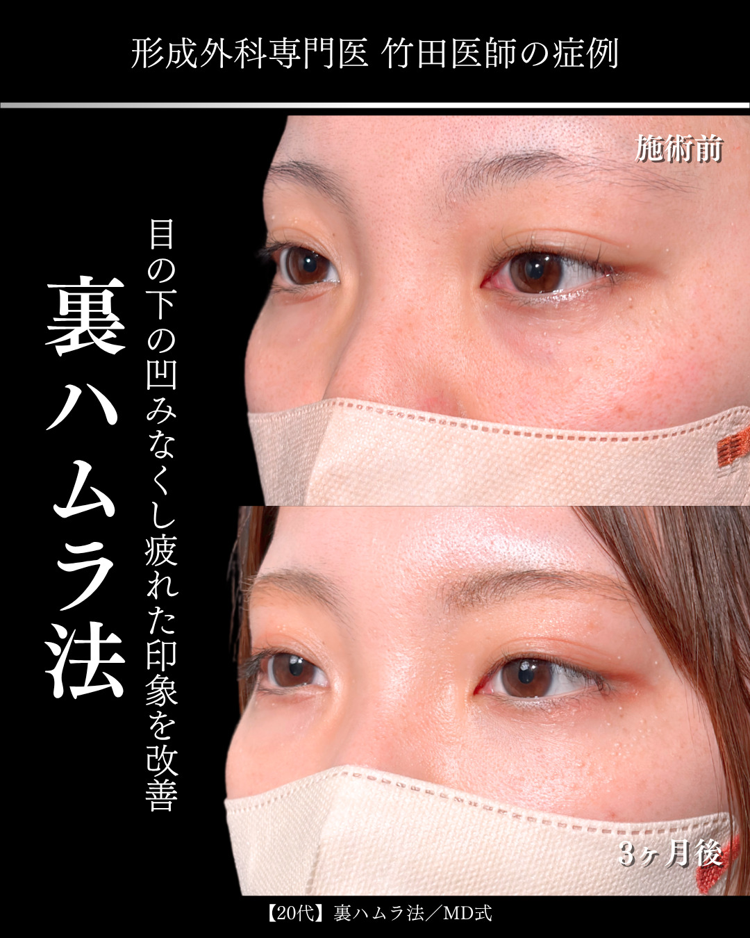 大宮院で行った裏ハムラ法で有名な名医の竹田昌平医師の症例写真
