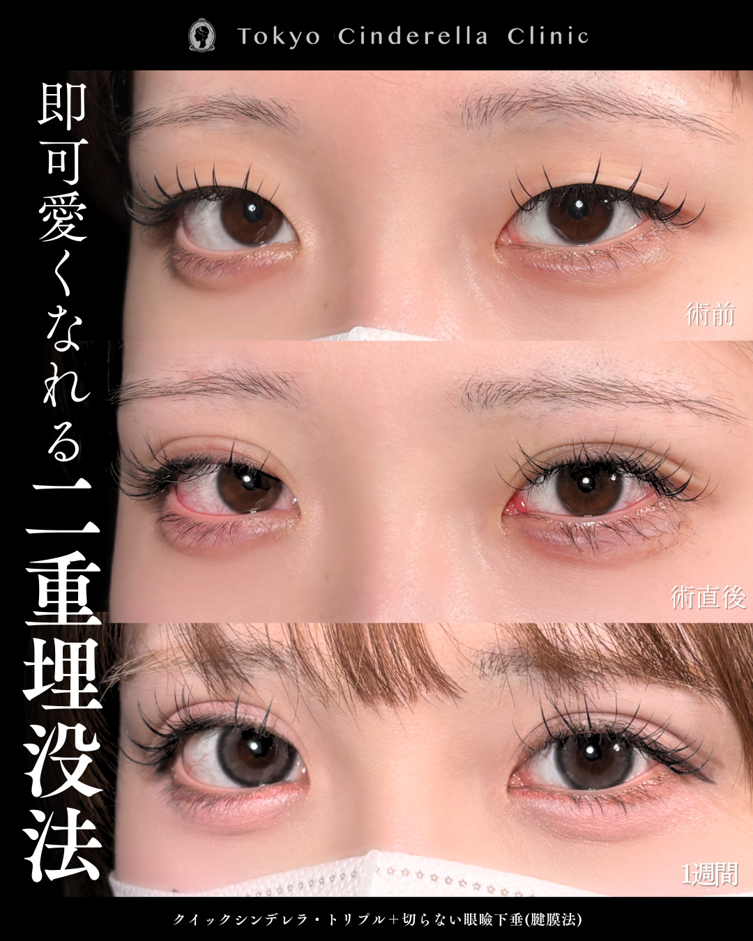 二重埋没のクイックシンデレラトリプルと切らない眼瞼下垂で1週間でぱっちり二重に
