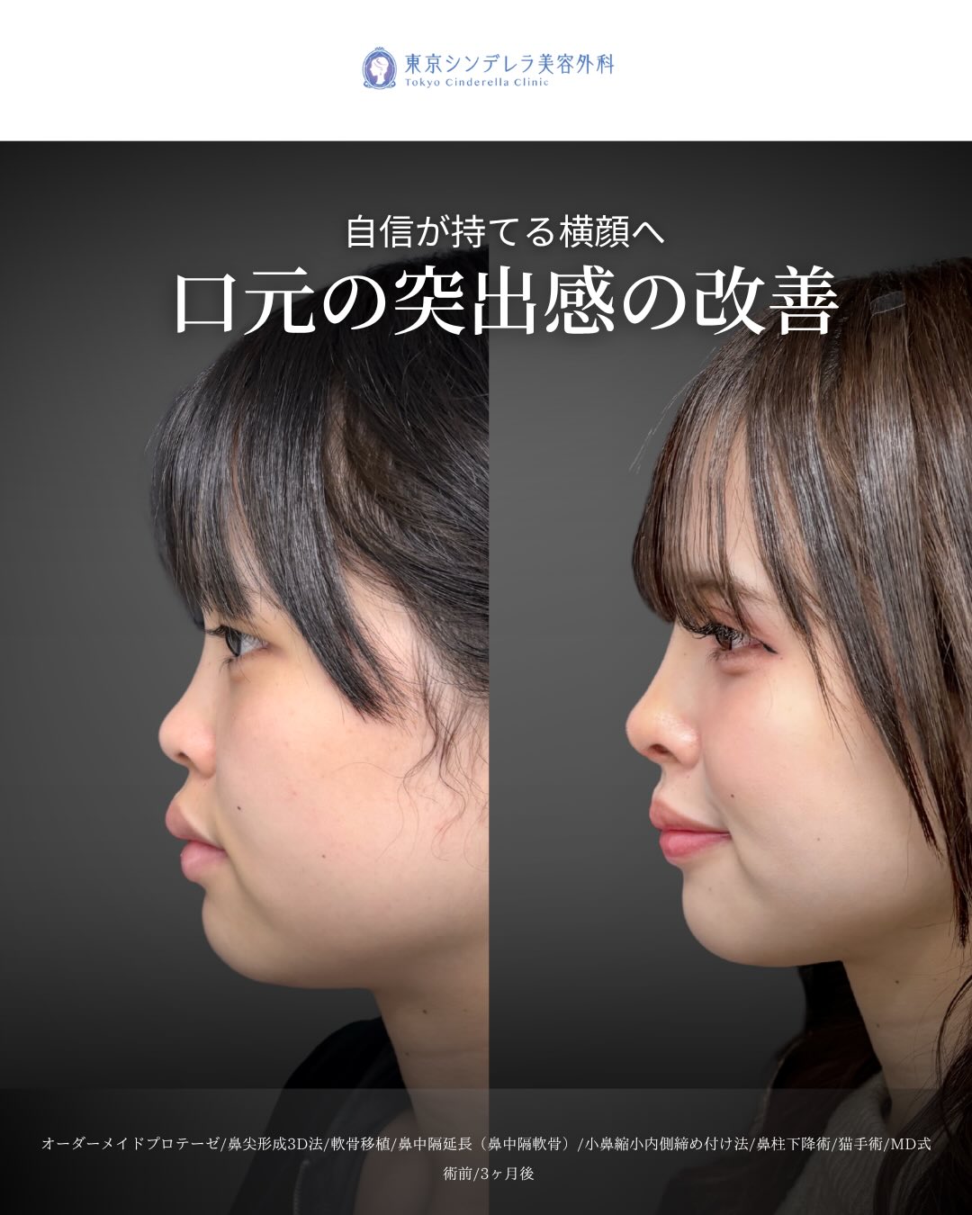 猫手術(鼻唇角形成術) の症例写真一覧｜ 新宿・池袋・大宮・横浜で人気
