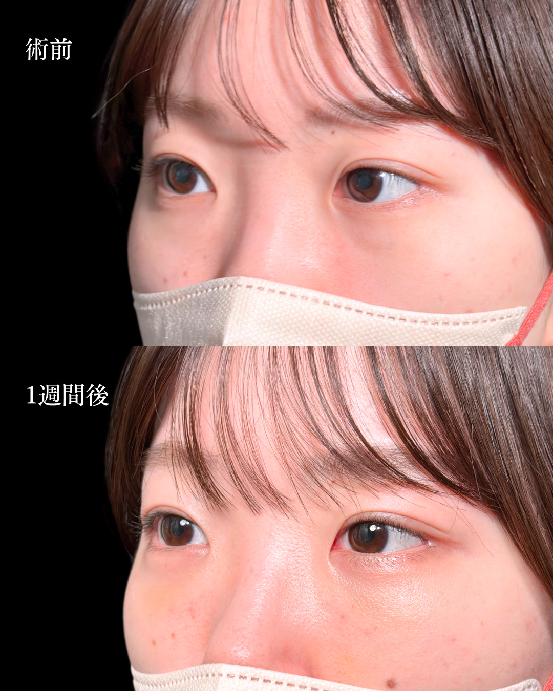 大宮院で行っ裏ハムラ法で有名な名医の竹田昌平医師の症例写真