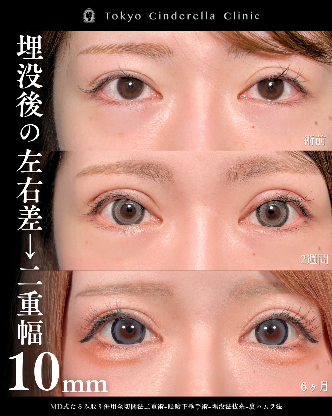 埋没後の左右差目元を全切開と眼瞼下垂と裏ハムラで平行二重になった20代女性の6ヶ月症例