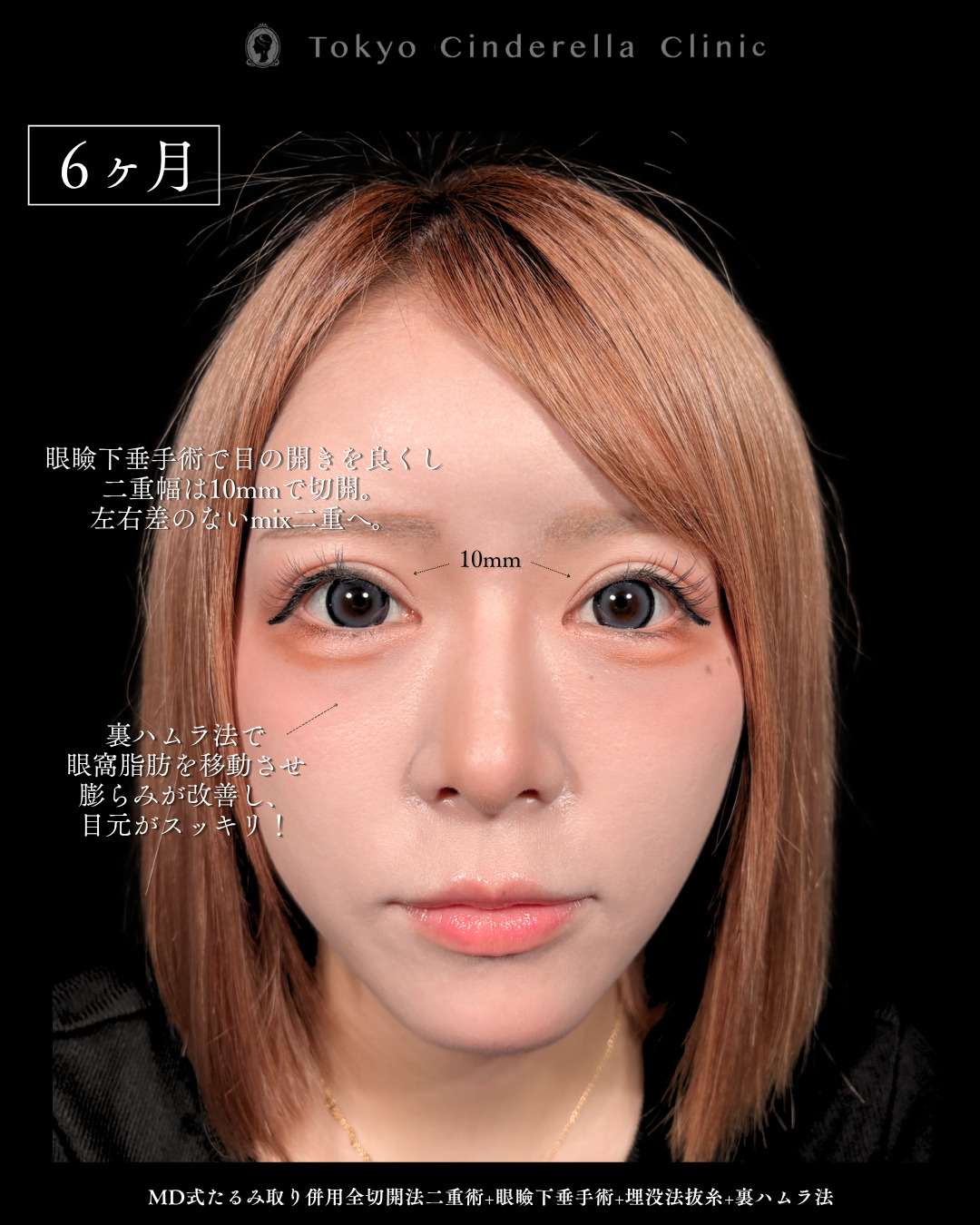 埋没後の左右差目元を全切開と眼瞼下垂と裏ハムラで平行二重になった20代女性の6ヶ月症例