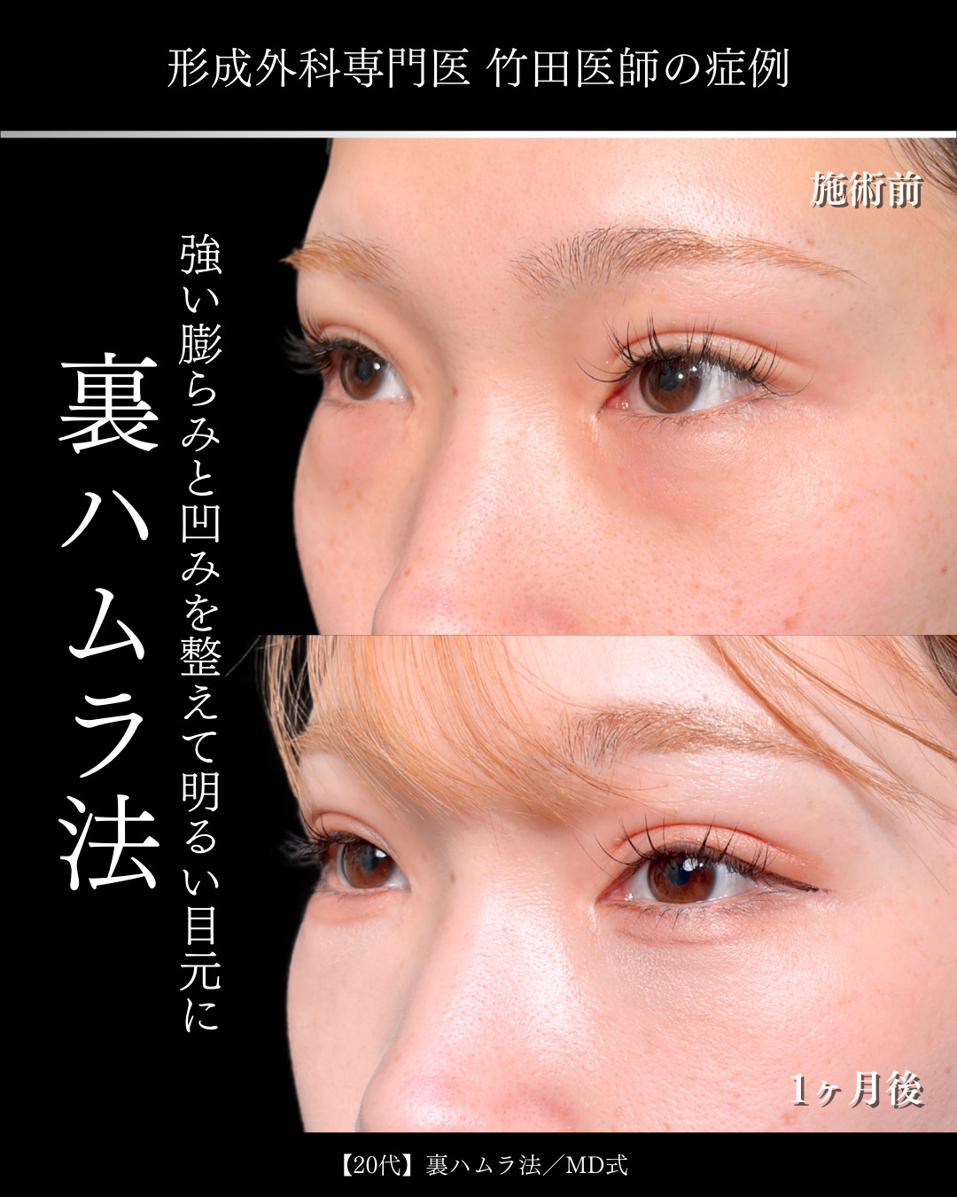大宮院で行った裏ハムラ法で有名な名医の竹田昌平医師の症例写真