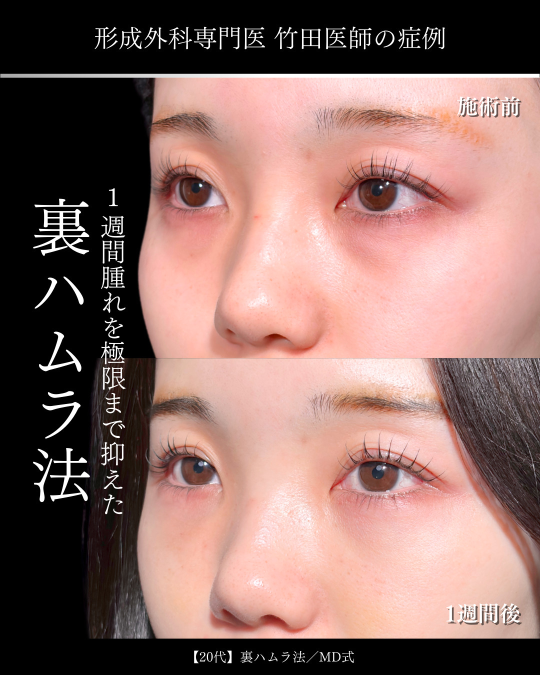 大宮院で行った裏ハムラ法で有名な名医の竹田昌平医師の症例写真