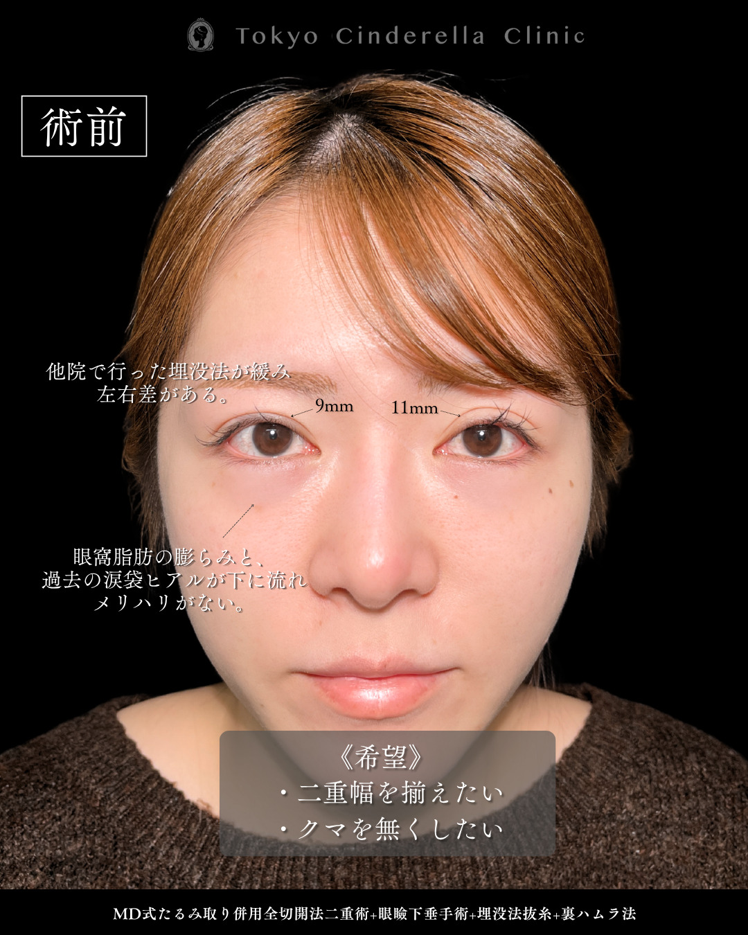 埋没後の左右差目元を全切開と眼瞼下垂と裏ハムラで平行二重になった20代女性の6ヶ月症例