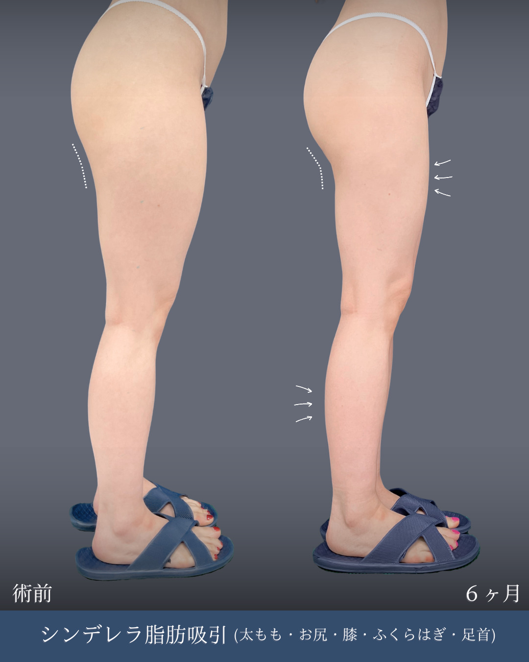 下半身脂肪吸引で美脚へ 」に関する美容整形の症例写真の詳細 | 新宿