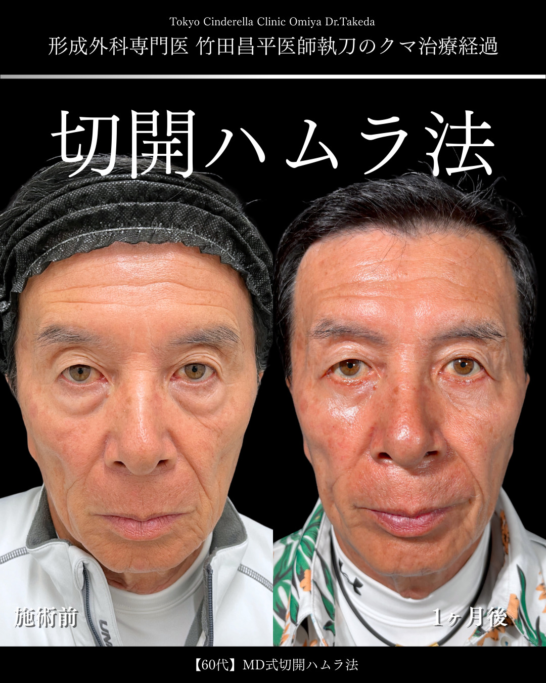 大宮院で行った切開ハムラで有名な名医の竹田昌平医師の症例写真