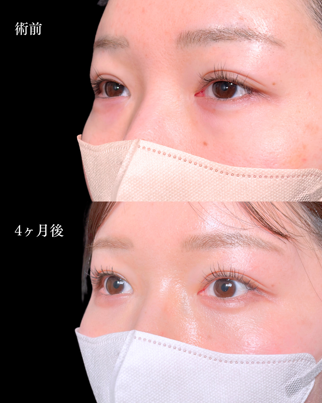 大宮院で行った裏ハムラ法で有名な名医の竹田昌平医師の症例写真