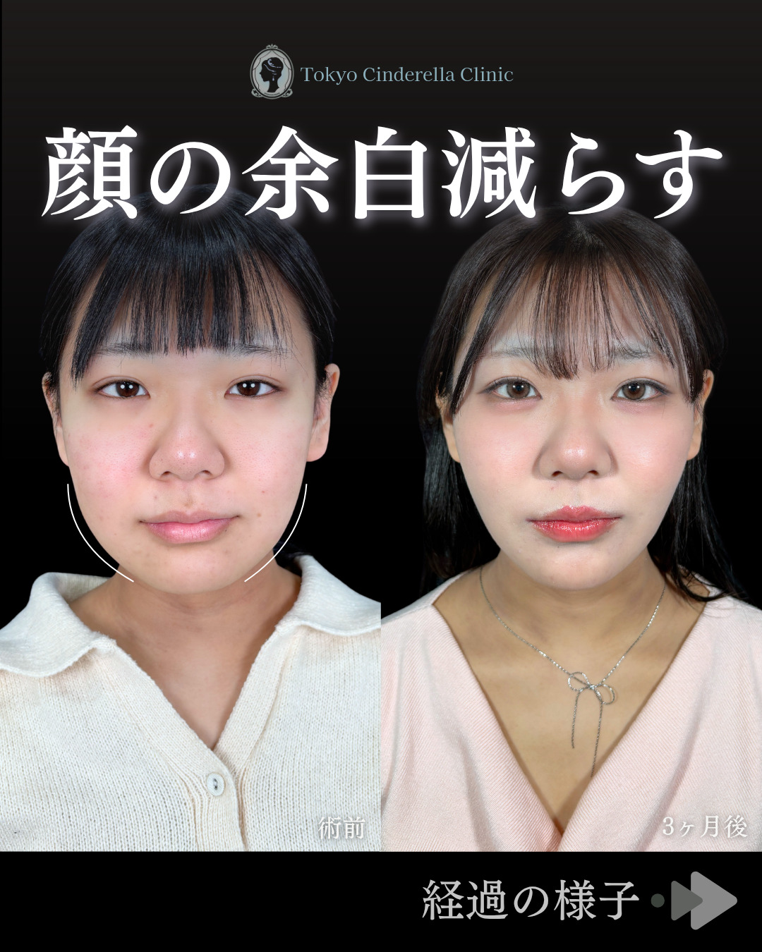顔 の 余白 を なくす 整形