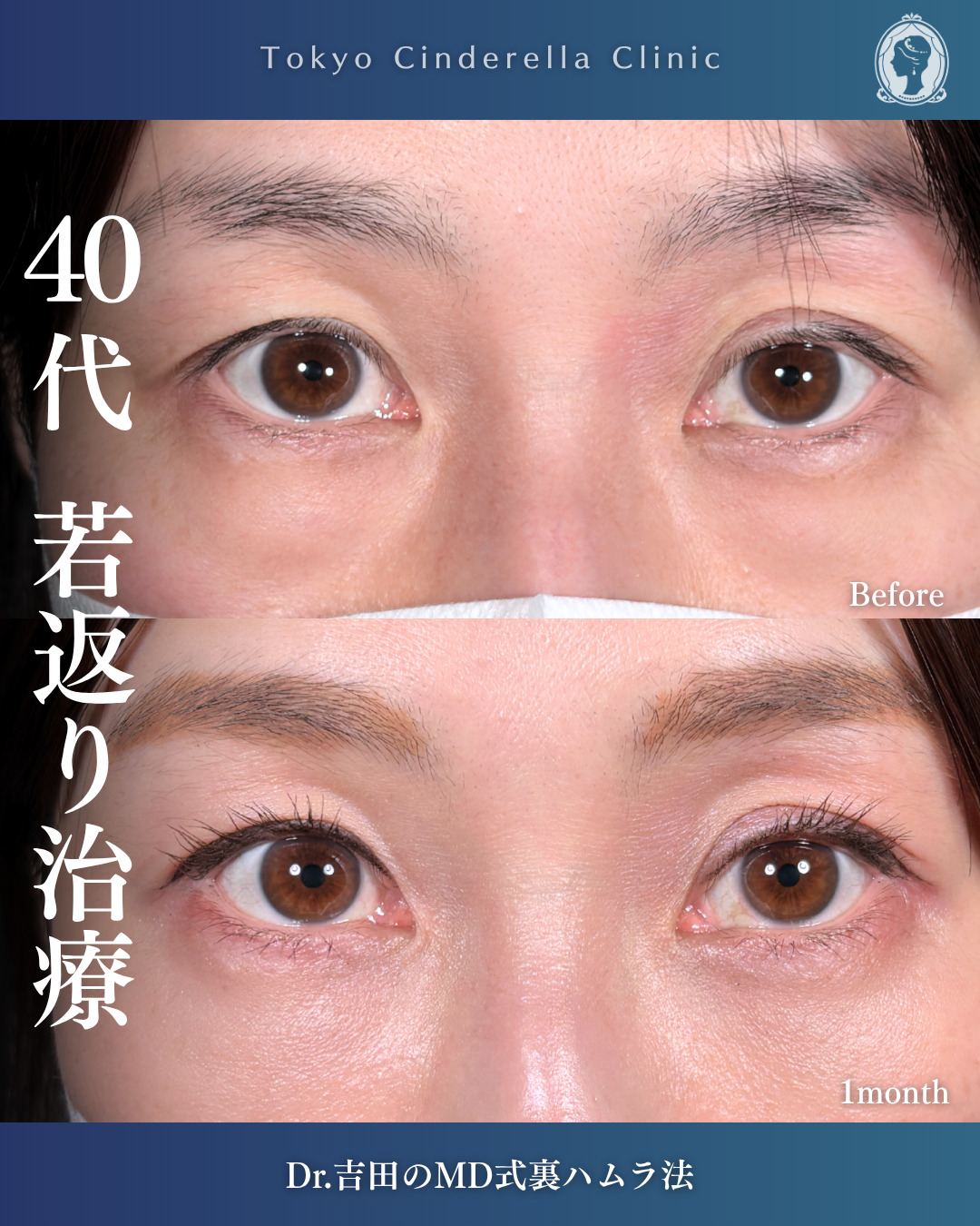 横浜院で行ったクマ取りの名医の吉田利之医師のMD式裏ハムラ法の1ヶ月後の症例写真