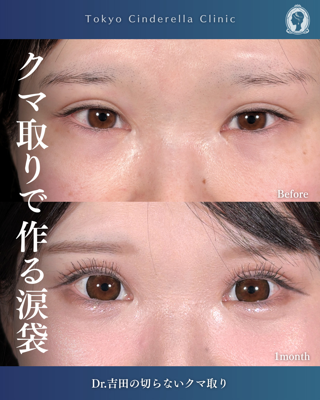 横浜院で行ったクマ取りの名医の吉田利之医師の切らないクマ取りの1ヶ月後の症例写真