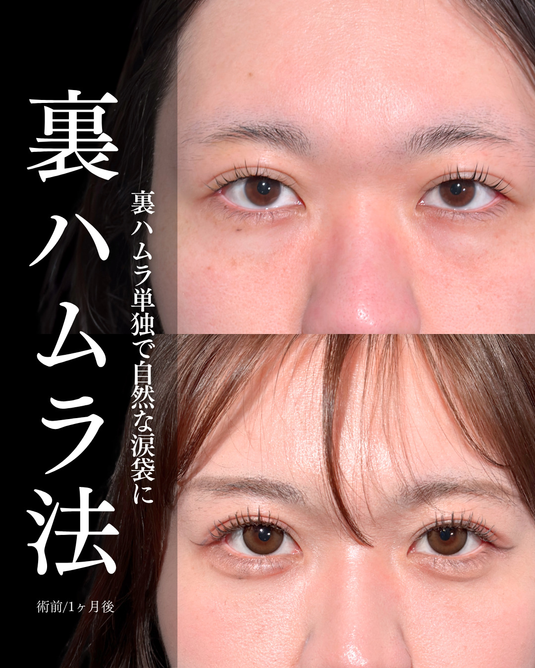 大宮院で行った裏ハムラで有名な名医の竹田昌平医師の症例写真