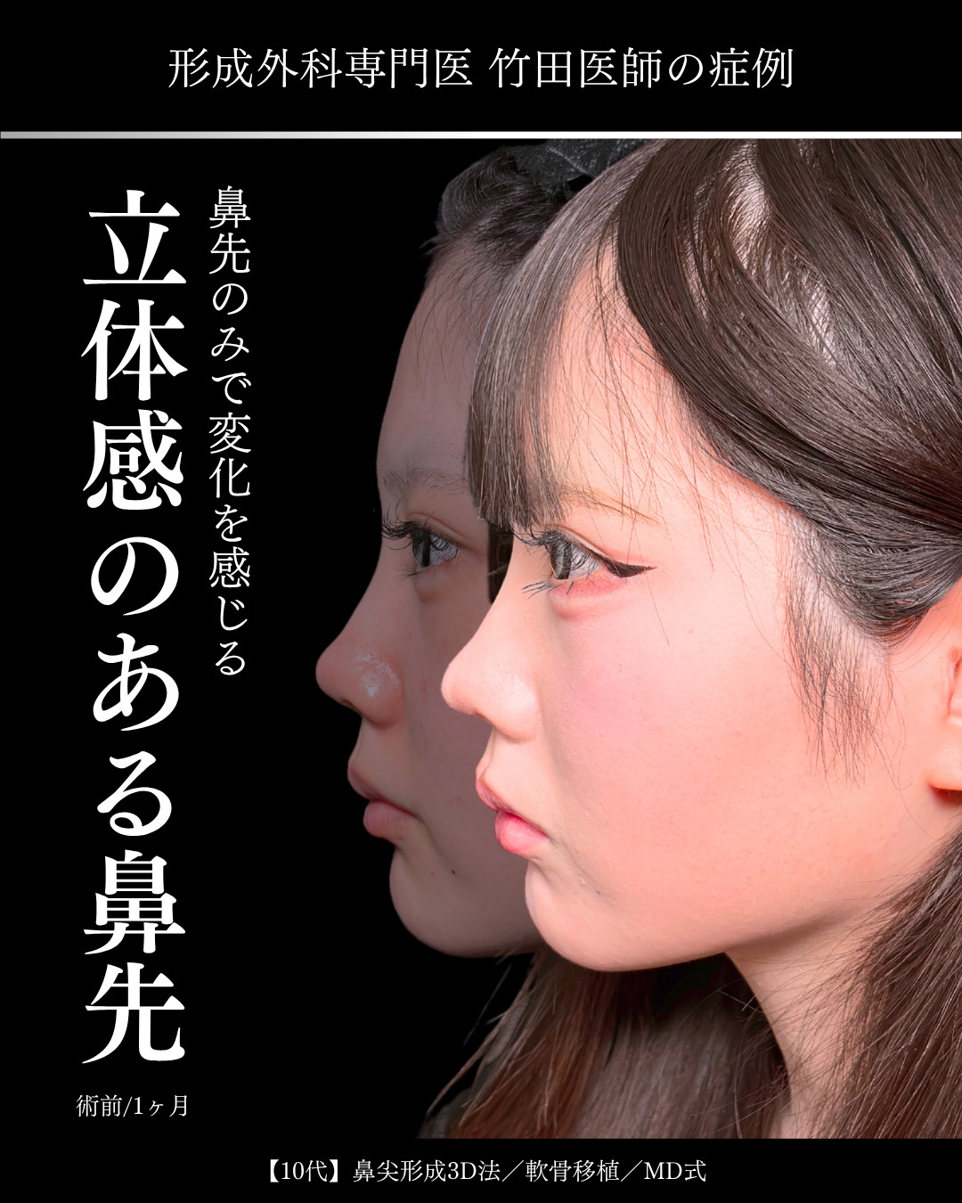 【中古】 本物の美容整形 鼻先のみで変化を感じる仕上がりに 」に関する美容整形の症例写真の