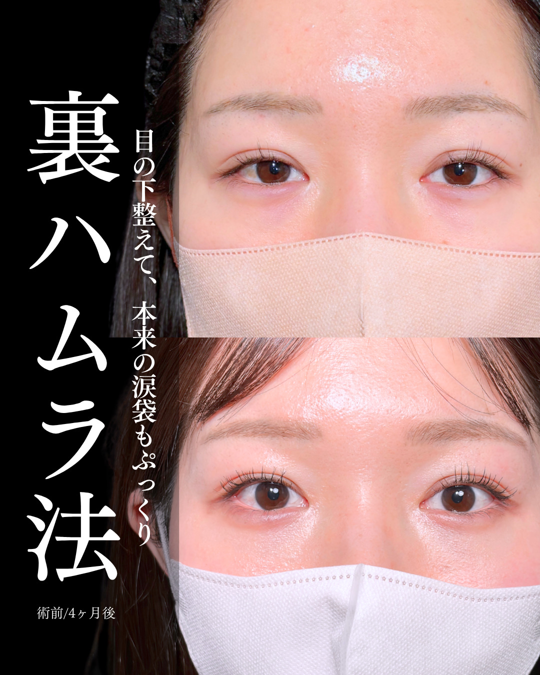 大宮院で行った裏ハムラ法で有名な名医の竹田昌平医師の症例写真