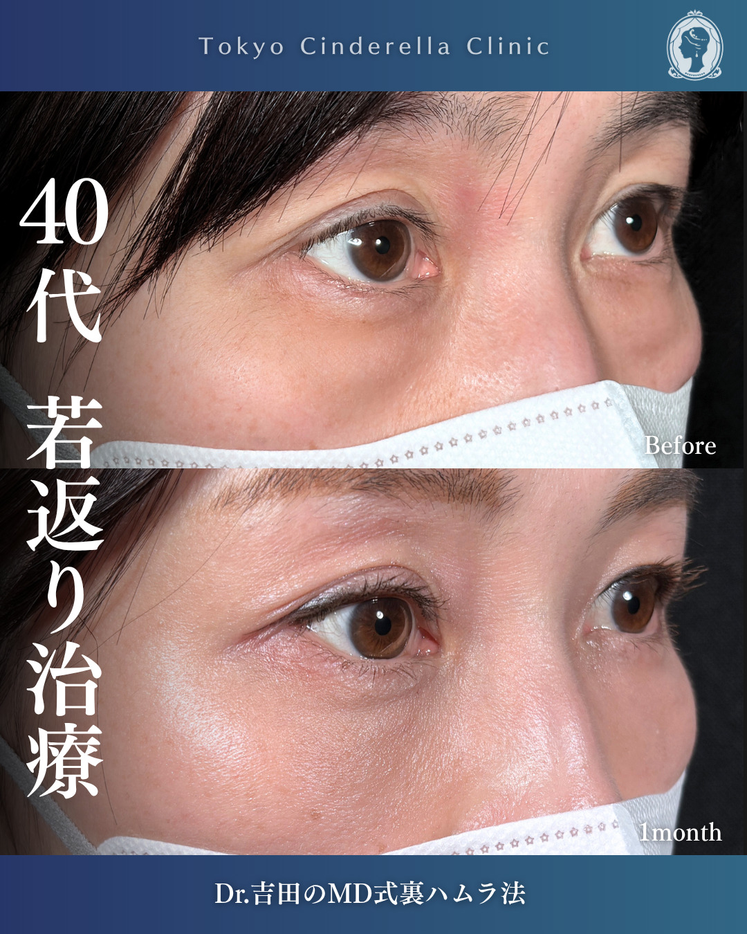 横浜院で行ったクマ取りの名医の吉田利之医師のMD式裏ハムラ法の1ヶ月後の症例写真