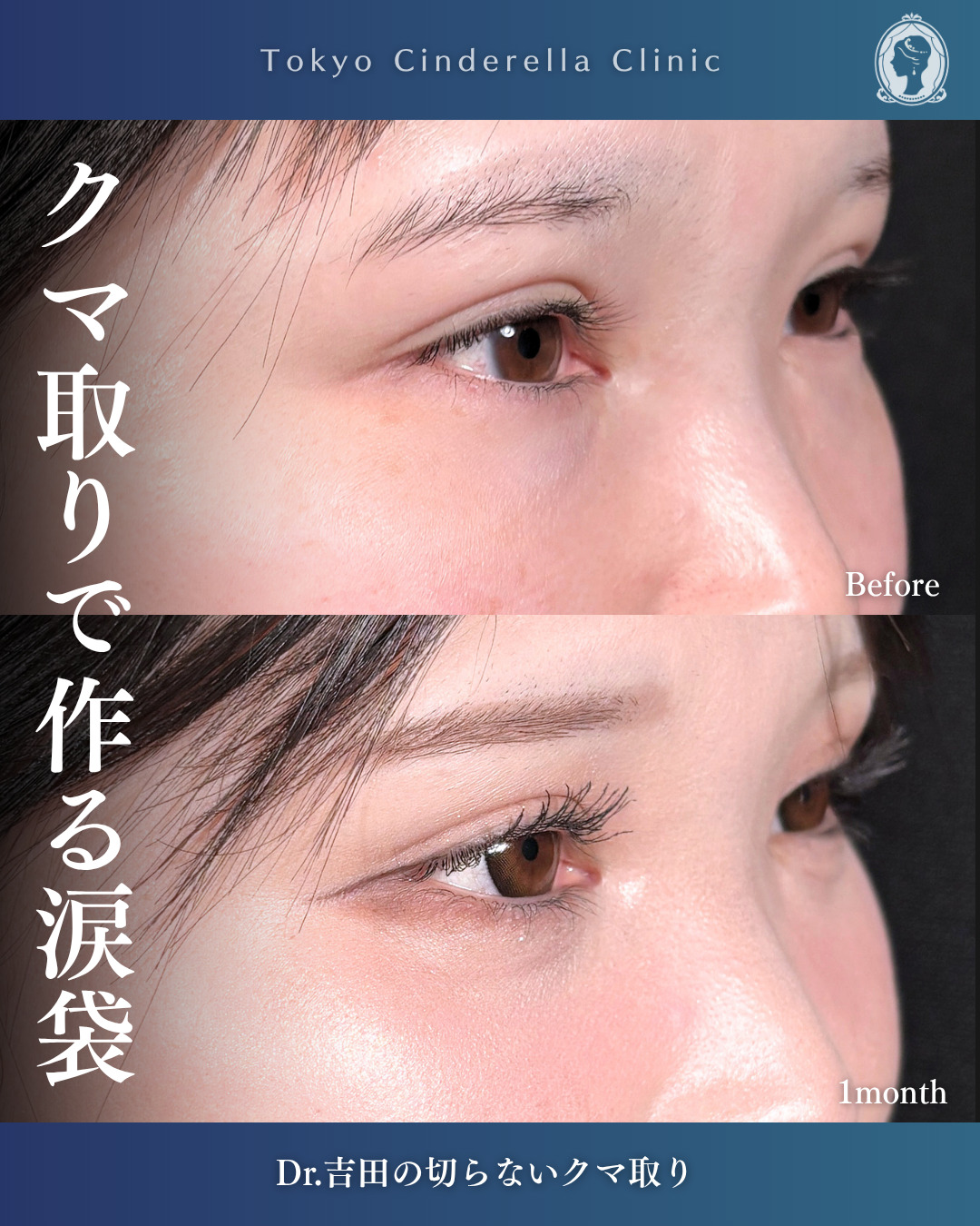 横浜院で行ったクマ取りの名医の吉田利之医師の切らないクマ取りの1ヶ月後の症例写真