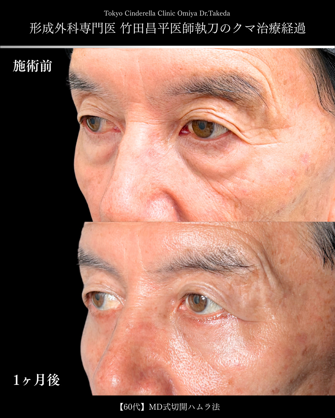 大宮院で行った切開ハムラで有名な名医の竹田昌平医師の症例写真