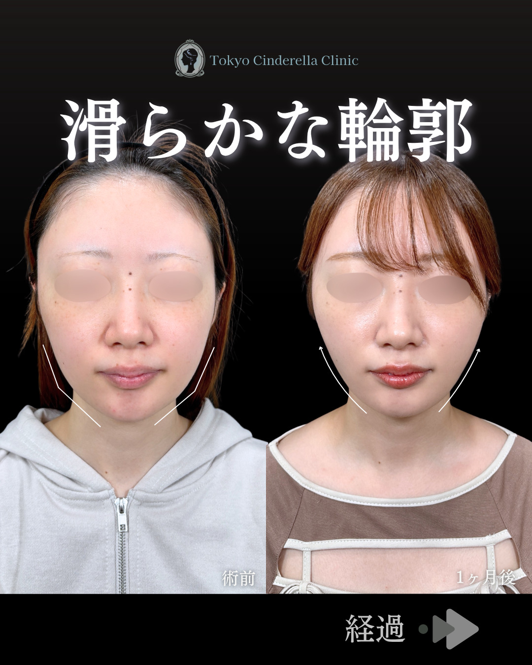 二重幅 二重幅8mm 」に関する美容整形の症例写真の詳細 | 新宿・池袋・大宮