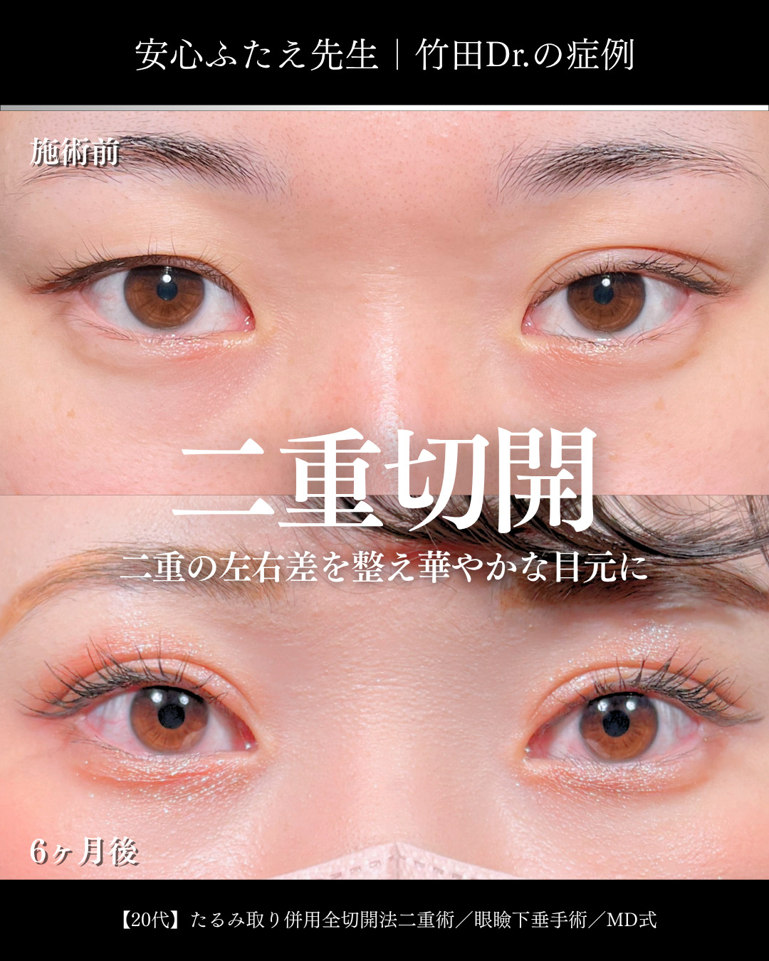 眼瞼下垂手術で目の開き改善 」に関する美容整形の症例写真の詳細