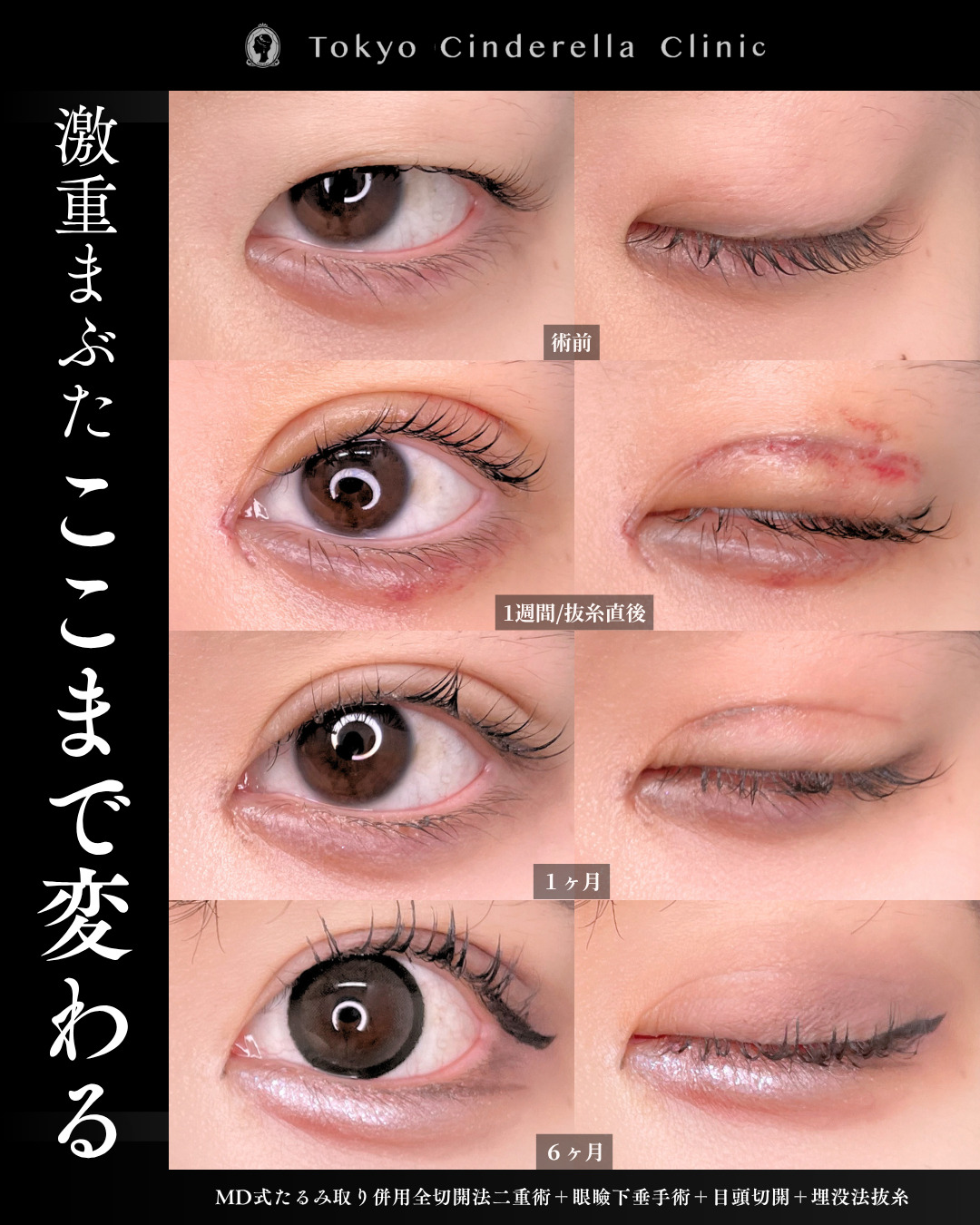 二重幅 二重幅8mm 」に関する美容整形の症例写真の詳細 | 新宿・池袋・大宮
