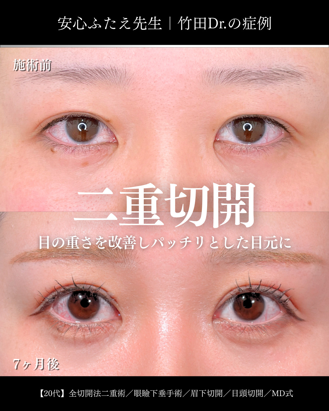 目の重さ改善パッチリ二重 」に関する美容整形の症例写真の詳細 | 新宿
