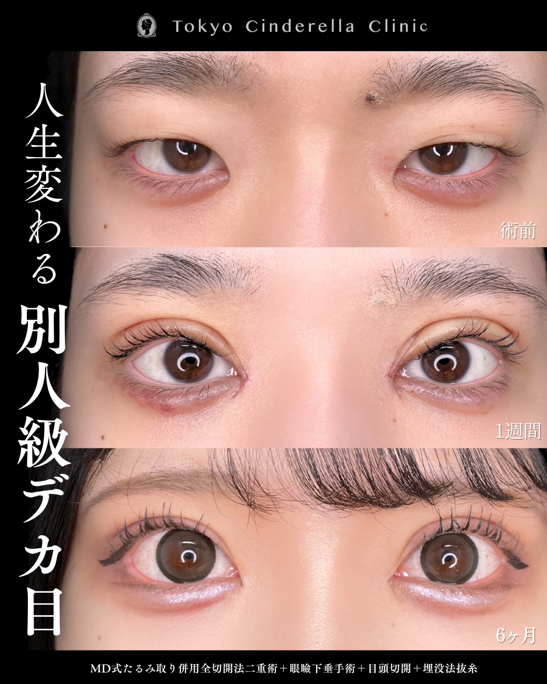 人生変わる二重整形 」に関する美容整形の症例写真の詳細 | 新宿・池袋