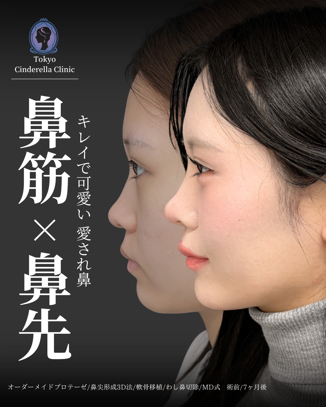新宿院で行った鼻整形の名医の吉原伯医師の症例写真