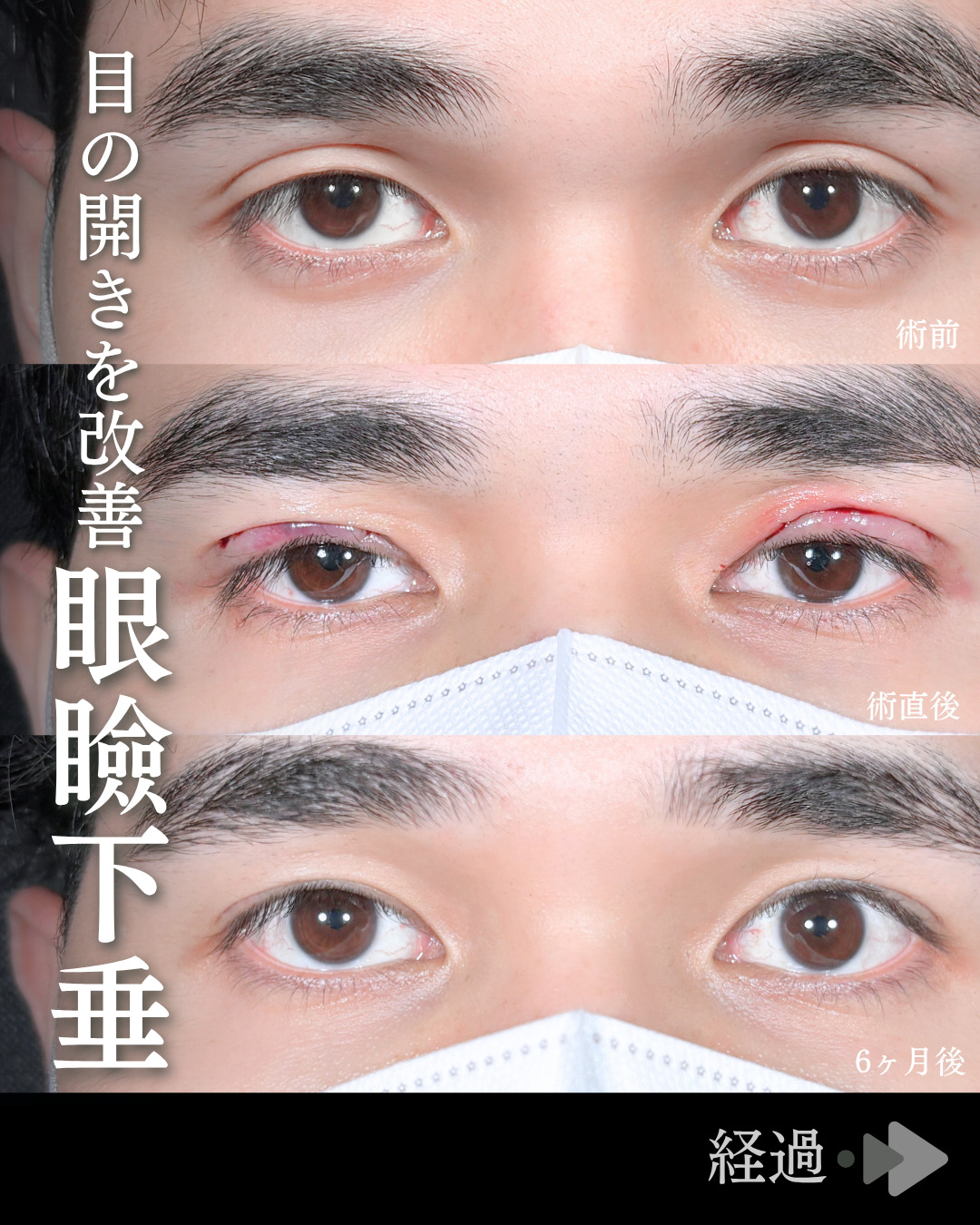 二重幅9mm 」に関する美容整形の症例写真の詳細 | 新宿・池袋・大宮