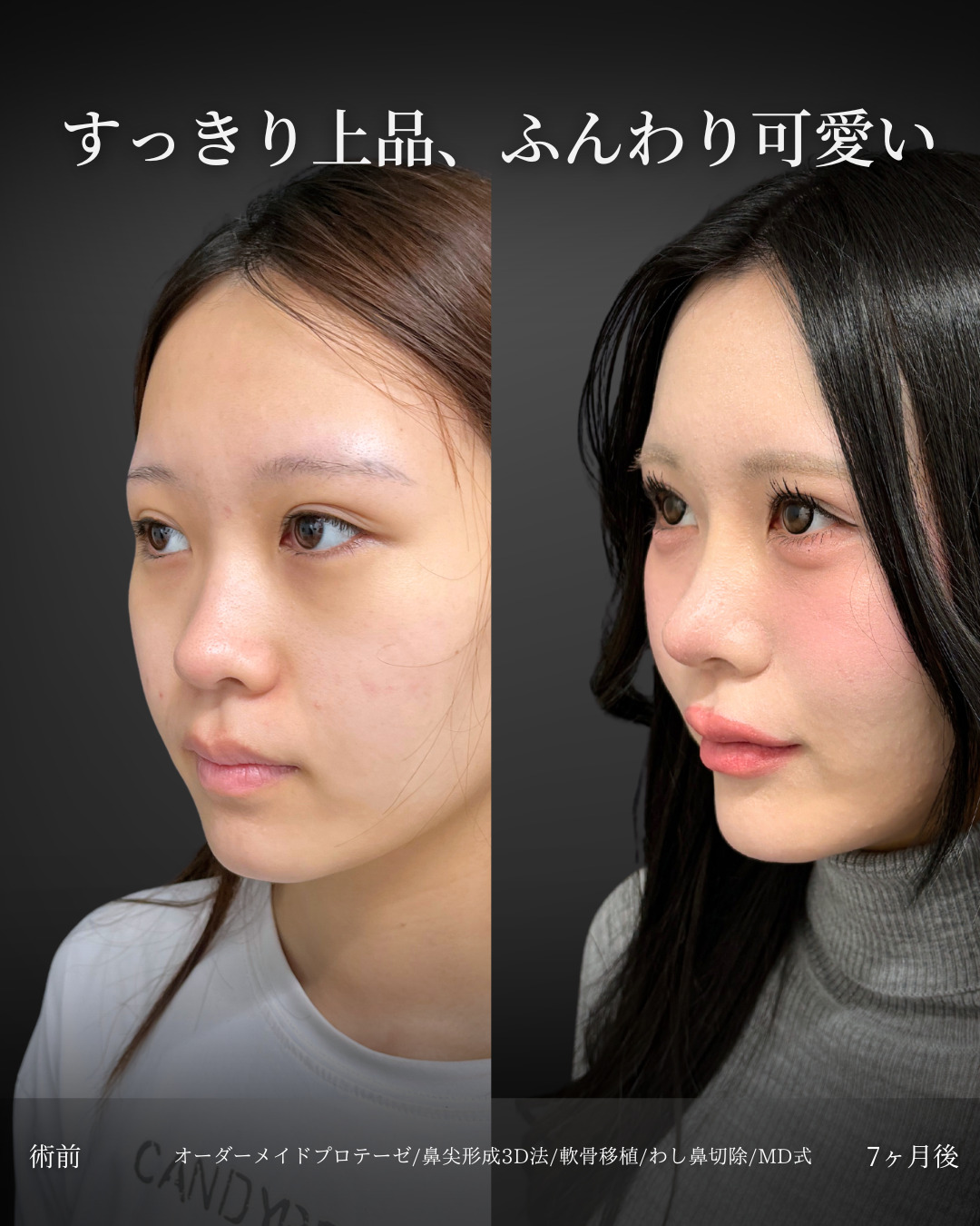 新宿院で行った鼻整形の名医の吉原伯医師の症例写真