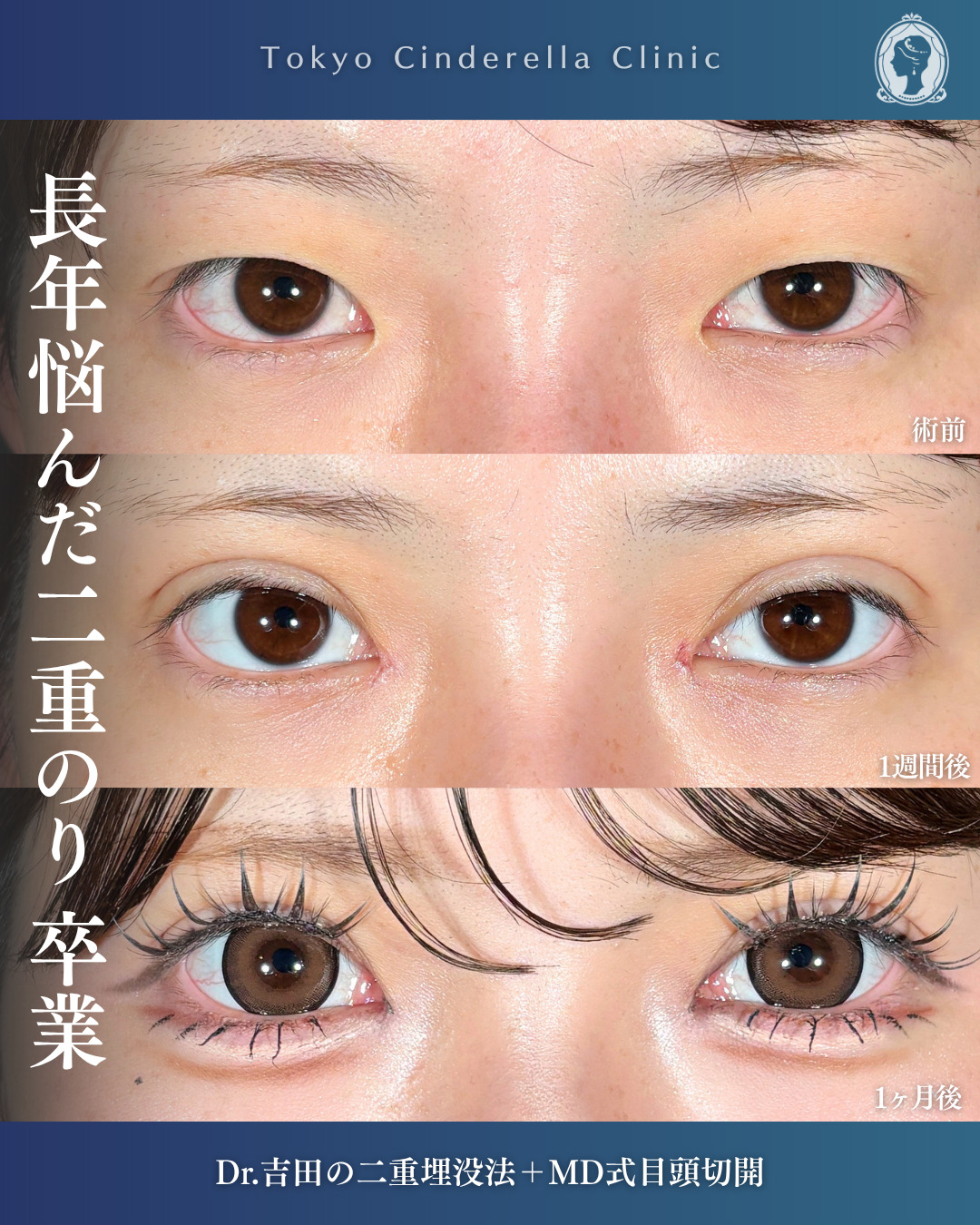 横浜院で行った二重整形の名医の吉田利之医師のMD式目頭切開と二重埋没法の1ヶ月後までのダウンタイム症例写真